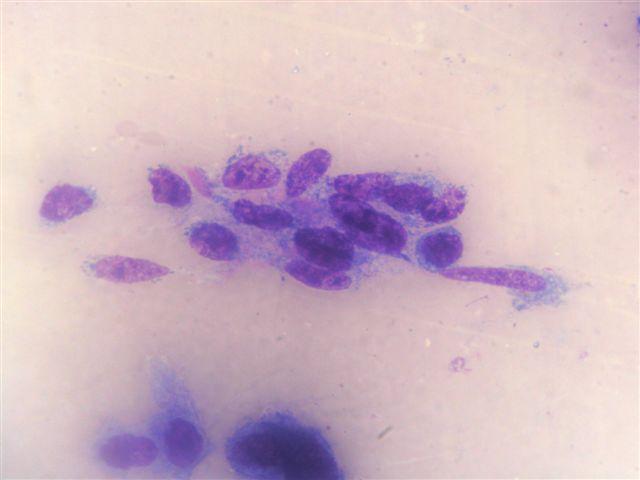 Cytologická diagnóza: dobře diferencovaný SCC. Histologická diagnóza: nespecifická rinitida. MayGrünwald/Giemsa, 250x. Obr.