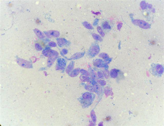 Histologická diagnóza: amelanotický maligní melanom. MayGrünwald/Giemsa, 250x Obr. 12: FNAB z útvaru na pysku (pes; samec; 8 let; knírač).