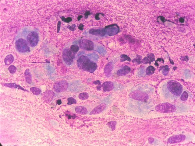 Histologická diagnóza: maligní fibrózní histiocytom. MayGrünwald/Giemsa, 250x Obr. 18: FNAB z útvaru na hrudníku (kočka; samec).