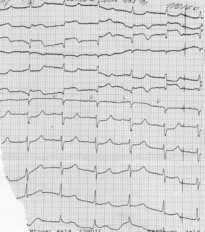 EKG Pardeeho vlny ve svodech