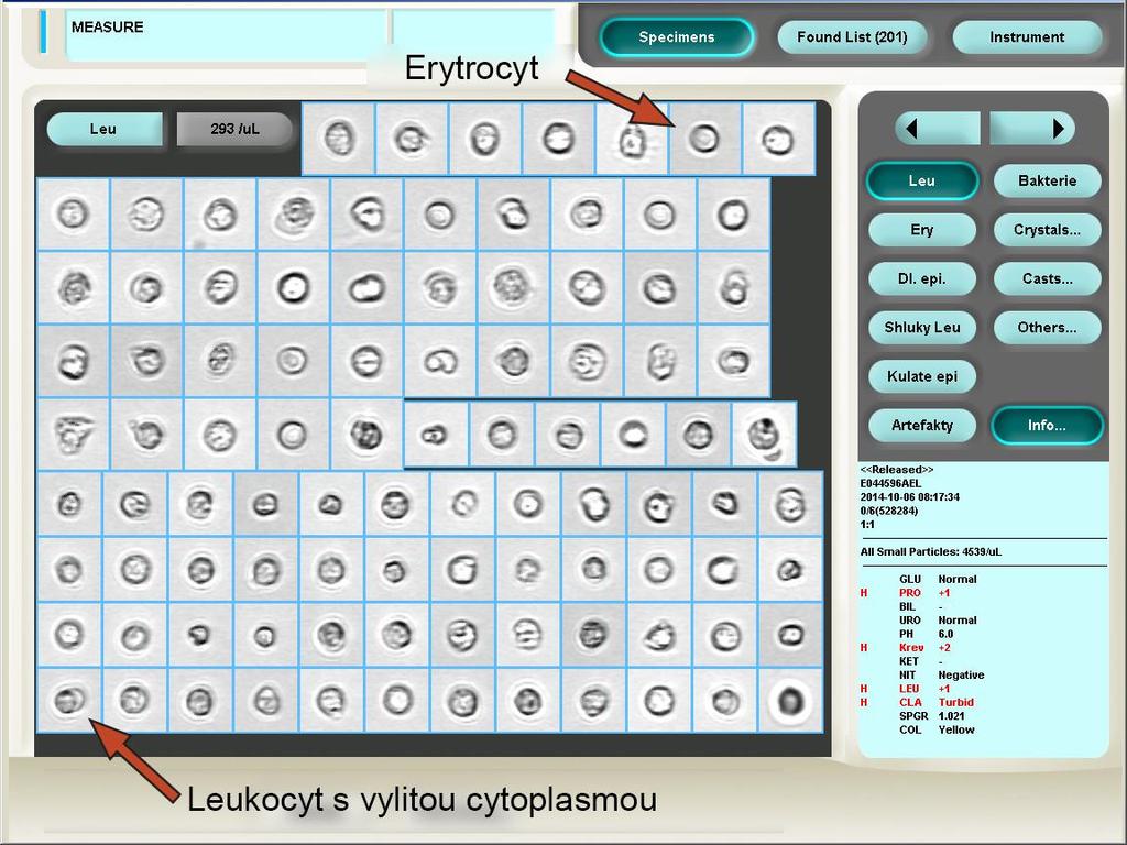 Elementy v hypotonické moči V hypotonické moči pacienta s akutním zánětem močového měchýře byly po úmyslném zavodňování nalezeny třpytivé buňky neutrofilní granulocyty vykazující Brownův pohyb