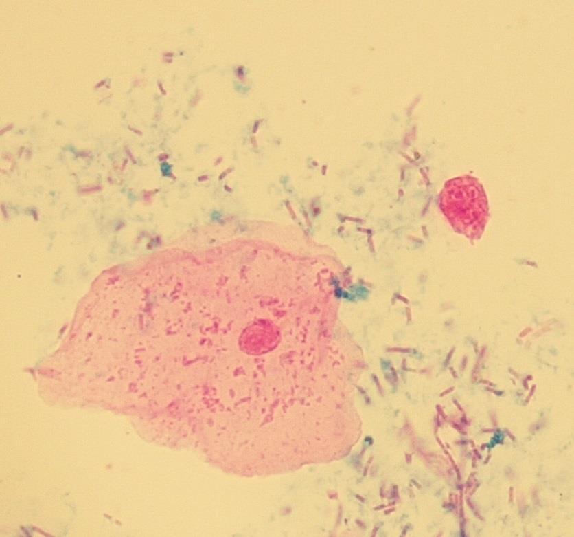 Při nedostatečné antibiotické léčbě mohou zůstat bakterie uvnitř buňky i v případech, kdy vně buňky
