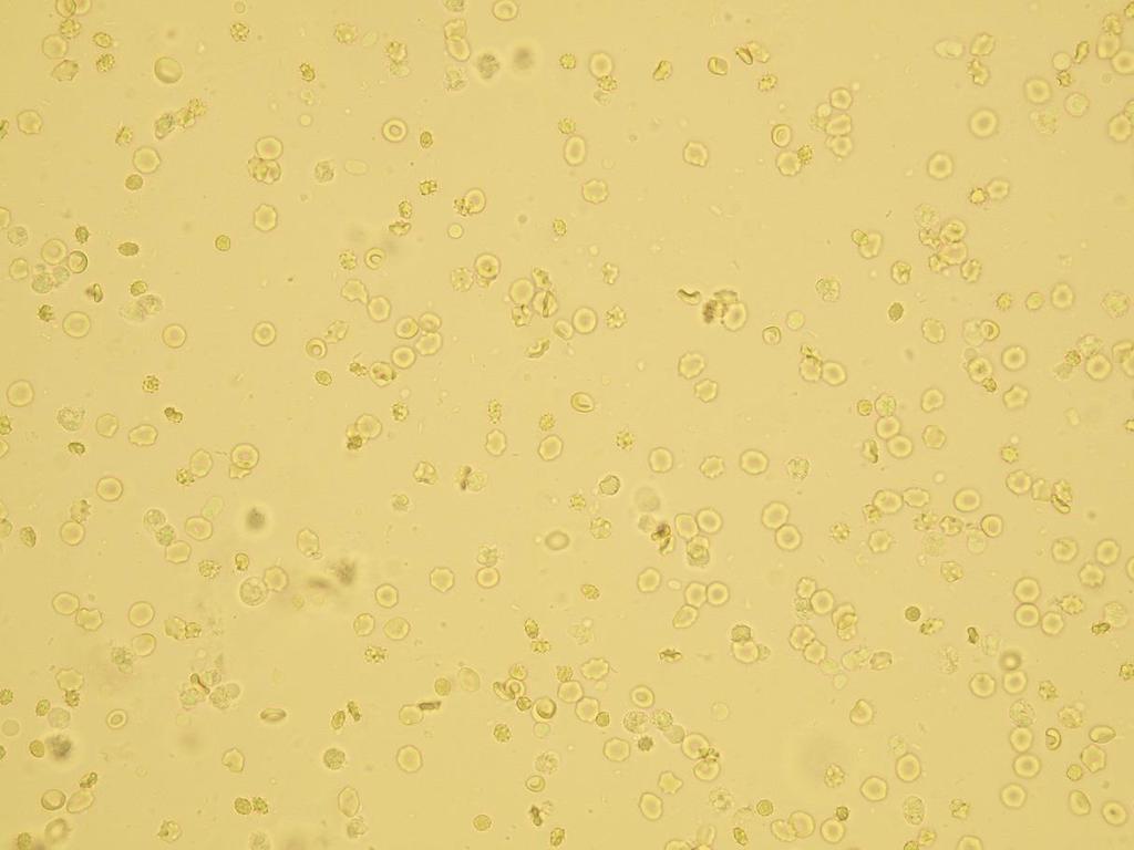 Erytrocyty deformované