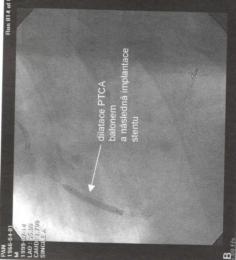 angioplastiky Obrázek 10 Akutní uzávěr Zdroj: Štejfa et