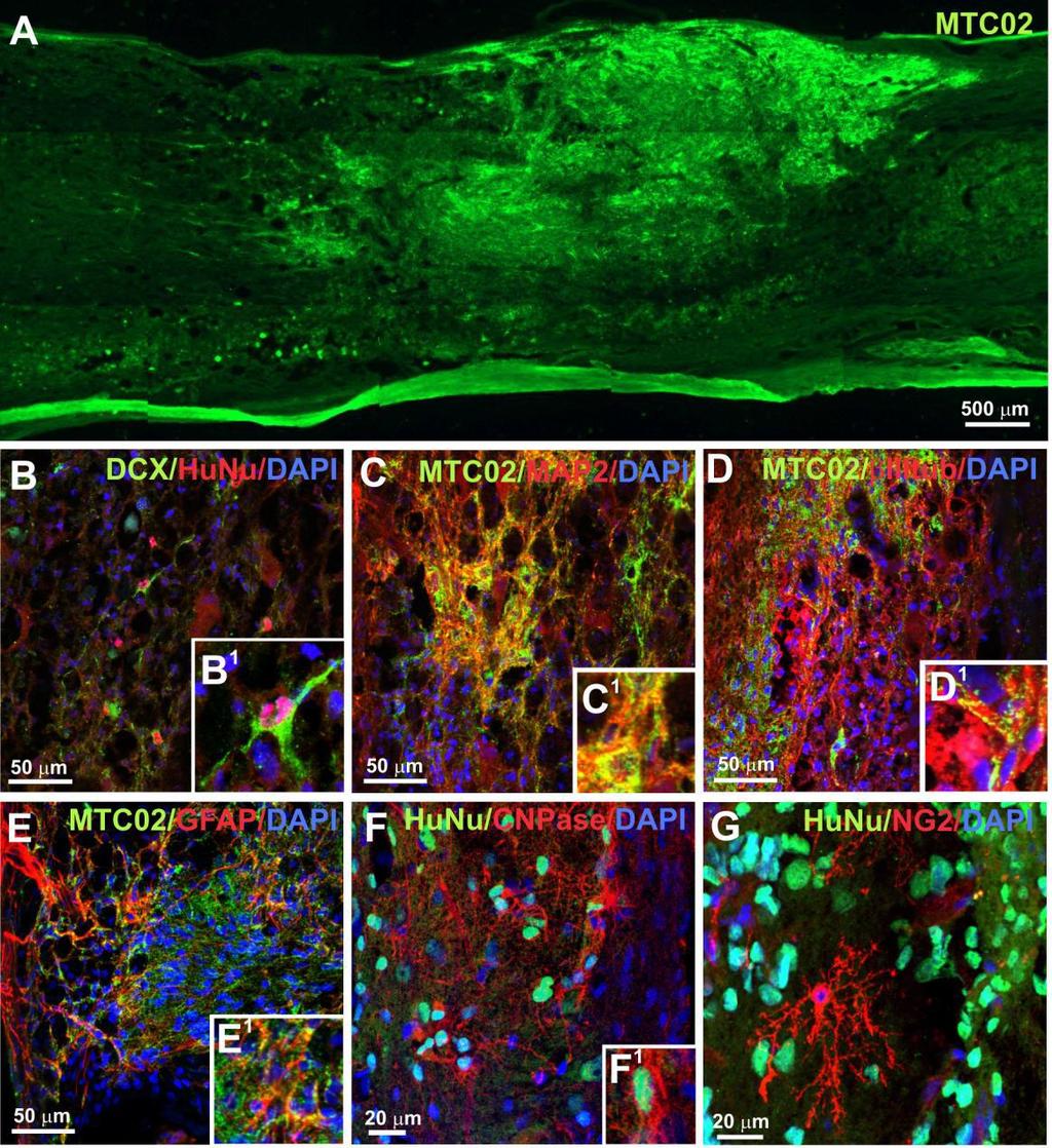 Obr. 7 ipscs-nps projevující imunoreaktivitu na NP marker (Nestin), astrogliální marker (GFAP), astrocytální marker (GLT1/ALDH1), oligodendrocytální