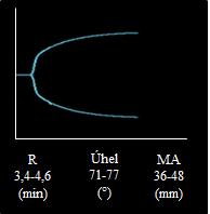 TEG křivky Porovnávali jsme tromboelastografické křivky TAD, TADK a plné krve. Každou křivku jsme hodnotili samostatně (Obrázek 10-12) a provedli jsme také souhrnné porovnání (Obrázek 13).