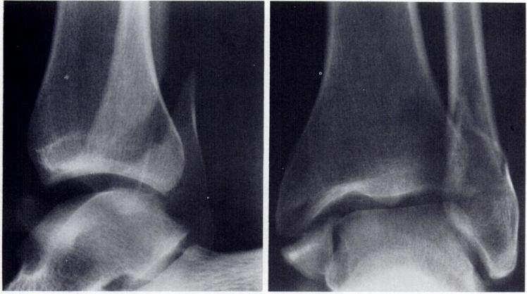 Supinačně-addukční fraktury Addukce talu supinované nohy způsobuje kompresi tibie a trakci laterálních struktur hlezna.