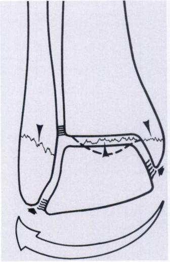 vertikální komprese (http://radiology.rsnajnls.org/cgi/reprint/138/1/55.pdf). Obr. 8. Distální tibie a fibula, pohled zezadu, šipka ukazuje zadní tibiální hrbolek (http://radiology.rsnajnls.org/cgi/reprint/138/1/55.pdf) 1.