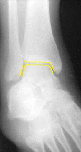 Příloha 2. Šikmý rentgenový snímek pravého TC kloubu, normální talokrurální vidlice (http://www.