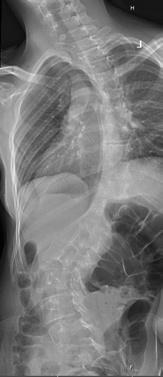 kapacity vnitřních orgánů. Konzervativní postup zahrnuje rehabilitační péči, léčbu korzety a ortézami, ale především ošetřovatelsko u péči s prevencí dekubitů.