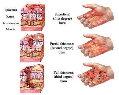 ZDROJ: http://health.allrefer.com/health/burns-first-degree-burn.