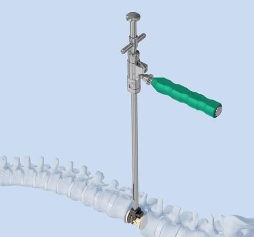 Vložení implantátu 7 Vložení implantátu 2 Nástroj 03.807.300 Rozpěra XRL Před vložením implantátu je možné otáčet násadu rozpěry v krocích po 90 na pomoc při vizualizaci.