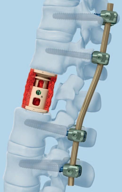 2 Použití doplňkové fixace XLR je indikován k použití s doplňkovou fixací