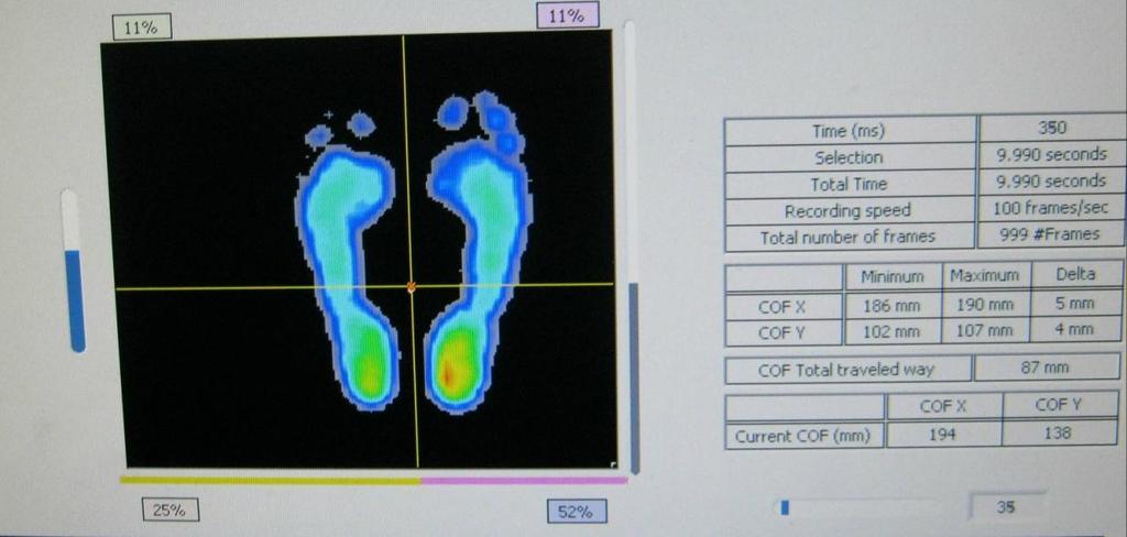 Pacient: P.D. STOJ 2 - Vstupní měření (vlastní foto) Tento snímek zobrazuje stoj o úzké bázi s otevřenýma očima při vstupním měření.