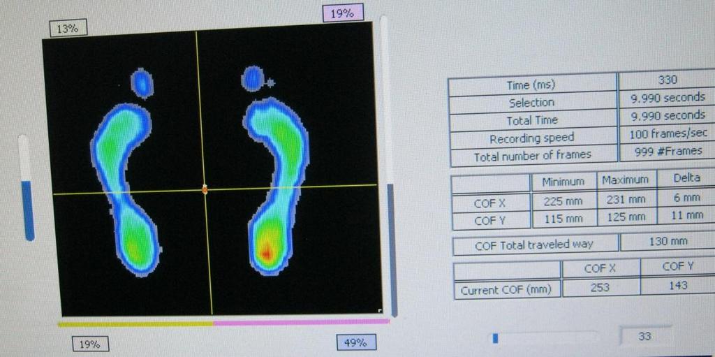 Pacient: M.P. STOJ 1 - Vstupní měření (vlastní foto) Tento snímek byl pořízen při vstupním vyšetření pacientky M.P. Vyplývá z něj, že největší zatížení nohy je směrem dorzálním, což potvrzuje i procentuální rozložení plochy v jednotlivých kvadrantech.