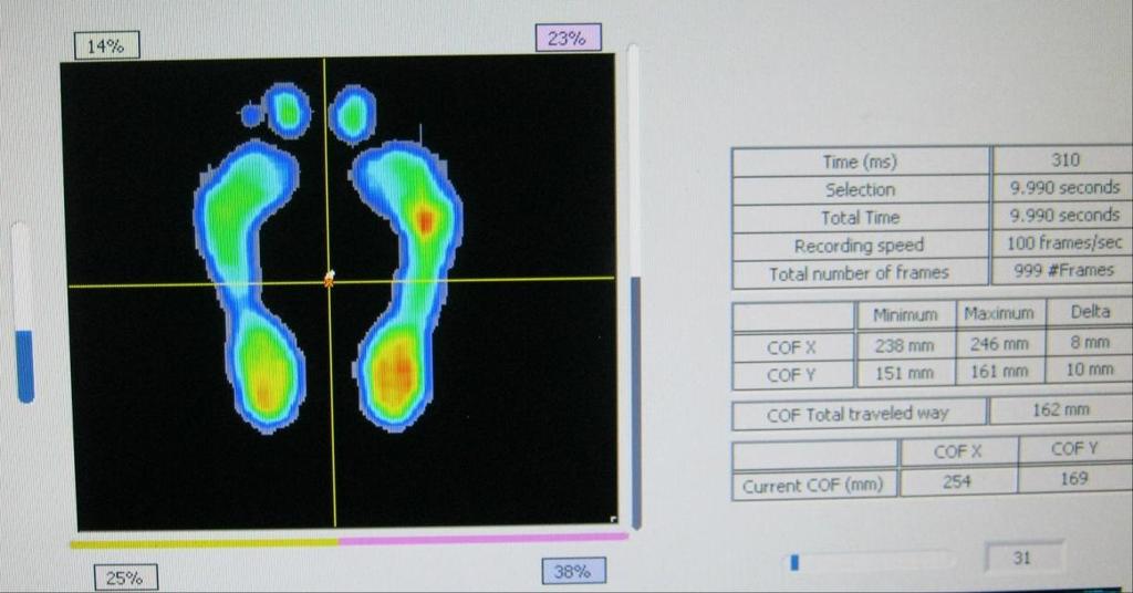 Pacient: M.P. STOJ 2 - Vstupní měření (vlastní foto) Z tohoto snímku vyplývá, že největší zatížení nohy je v oblasti mediální strany paty a v oblasti přednoží, přičemž pravá noha je zatěžována více než levá.