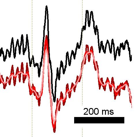 Obr. 21 Vliv horních filtrů na zátěžový signál EKG. Filtry jsou postupně přidávány: EKG, filtr 0-0.8 (1. kanál); filtr 0-0.8, 48-max (2. kanál); filtr 0-0.8, 48-max, vyhlazeni přes 20 bodů (3.