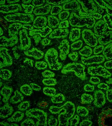 Detekce vysoce specifických protilátek třídy IgG proti mitochondriím je důležitým vyšetřením vedoucím ke správné diagnóze onemocnění.