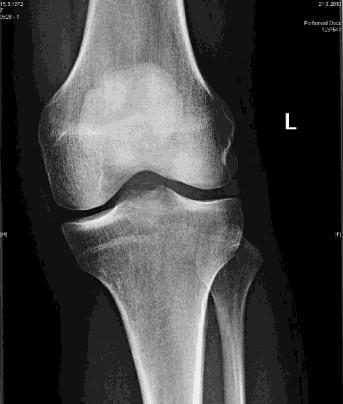 3. Vyšetřovací metody 3.1. Prostý snímek Mezi radiodiagnostickými metodami zaujímá vedoucí postavení klasické rentgenové vyšetření (obr.7).