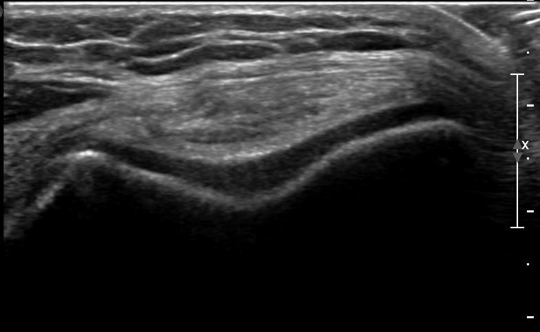 3.2. Ultrasonografie Ultrasonografie má v zobrazování hyalinní chrupavky nepatrnou roli.