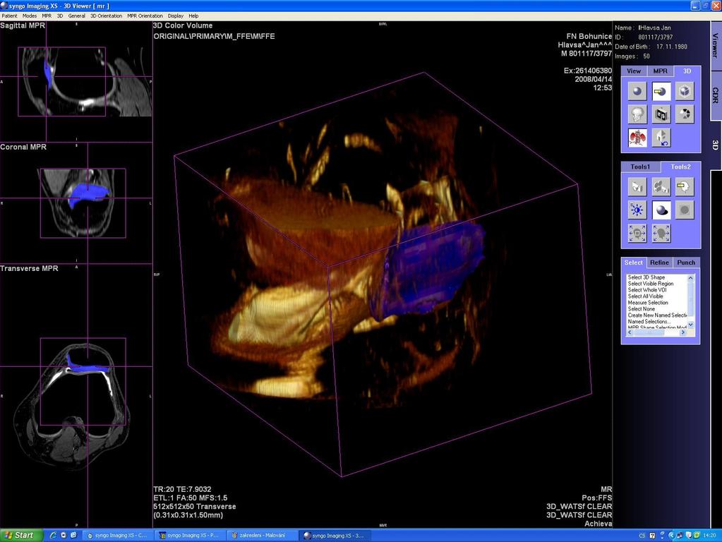 Obr. 23 : Program SyngoImaging XS VA60A ve třetím kroku vyhodnotí objem