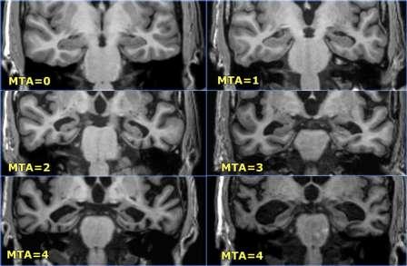 Brain 2009;132:195-203 The Author (2008).