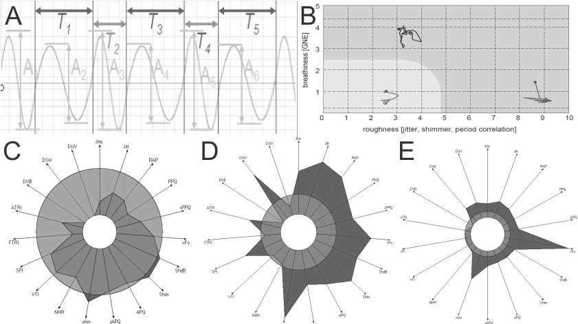 Obr. 3 Zobrazení akustických parametr hlasu na základ zpracování signálu (signal processing).. A) Základní parametry nestability akustického signálu: jitter nestabilita periodicity T1, T2,.