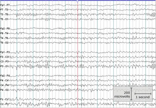 Epilepsie Diagnostika EEG Snímá postsynaptické potenciály