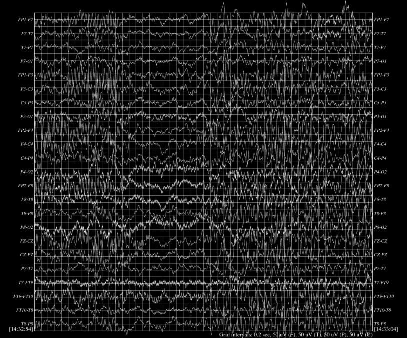 org/pn6/chbmit/ Komplexy