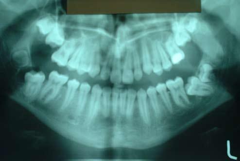 Obr. 1: OPG před výkonem. Obr. 2: Detailní pohled na zuby 37 a 38. Obr. 3: OPG po autotransplantaci.