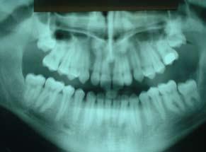 V dolní čelisti je patrno dentitio difficilis zubu 47 s vysoko ve větvi uloženým zárodkem zubu 48, dále zaklíněný mediálně skloněný zub 37 se zárodkem zubu 38.