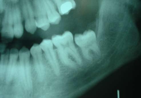 Následně byl uvolněn zub 38 ze svého původního místa a po odstranění většiny perikoronárního vaku byl vložen do lůžka po zubu 37 ve stabilní poloze a přešit mukoperiostem (obr. 3, 4).