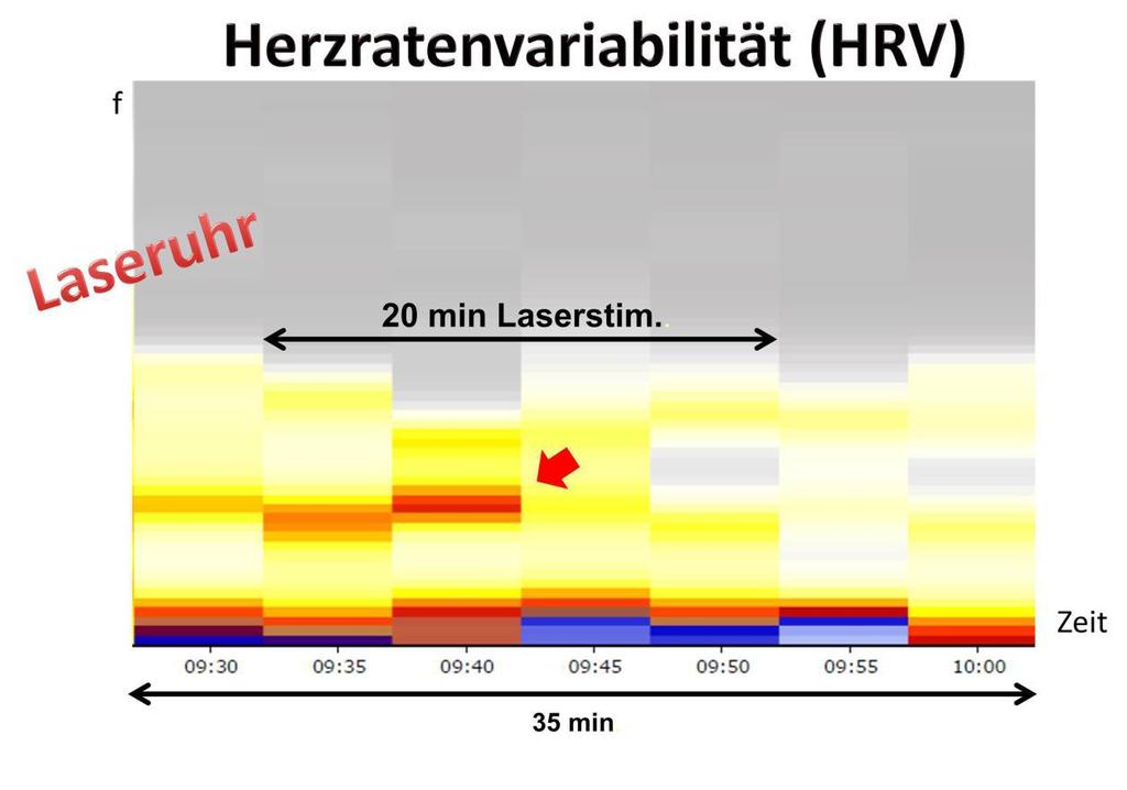 Diagram: Variabilita srdeční frekvence (HRV) Laser hodinky 20 minut laserové stimulace Čas Obr. 4: Variabilita srdeční frekvence v průběhu stimulaci laserem.