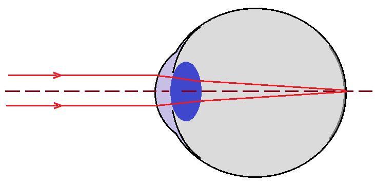 Na vedlejším obrázku je znázorněno zdravé oko. Vidíme na něm dva paprsky, které přichází rovnoběžně s optickou osou oka (čárkovaná čára).