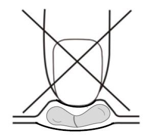 - cyklosporin, everolimus, sirolimus nebo takrolimus (prevence odmítnutí štěpu) - cyklofosfamid, vinka alkaloidy (vinkristin, vinblastin nebo podobné léky) používané k léčbě rakoviny - halofantrin
