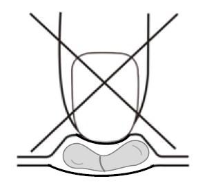 - cyklosporin, everolimus, sirolimus nebo takrolimus (prevence odmítnutí štěpu) - cyklofosfamid, vinka alkaloidy (vinkristin, vinblastin nebo podobné léky) používané k léčbě rakoviny - halofantrin