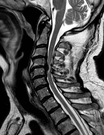 Spinální stenóza Cervikální