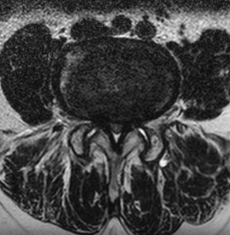 kvantifikace problematická chabá korelace s klinikou měření plochy [Sirvanci, 2008] obraz