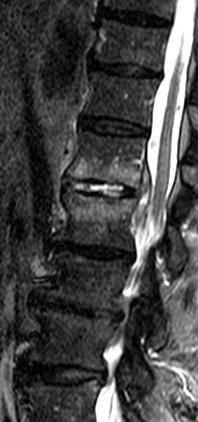 Diferenciální diagnostika Spondylodiscitis zánětlivé postižení