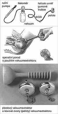 Příloha 3 Porod vakuumextrakcí ZDROJ: PORODNÍCI.