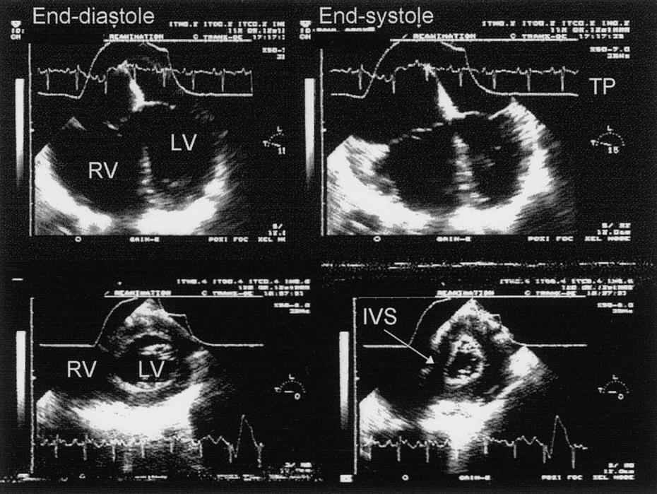 Is there a safe plateau pressure in ARDS: the right heart only knows F.Jardin, A.