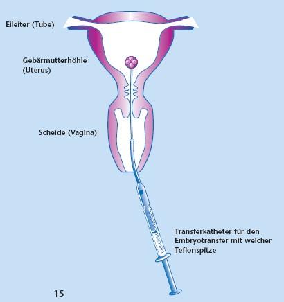 6. Těhotenství Asi za dva týdny po přenosu následuje hormonální analýza a ultrazvukové vyšetření pro potvrzení těhotenství.