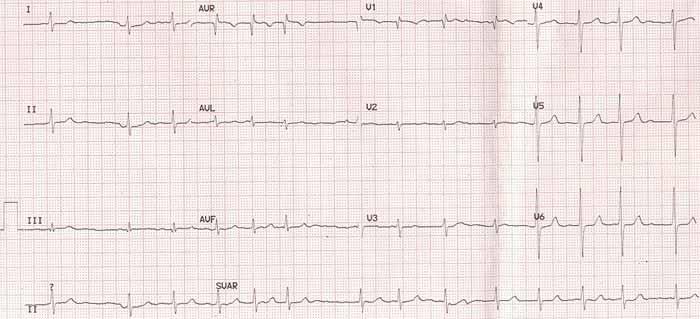 FRLCE SÍNÍ - PRVNÍ VYDÁNÍ 2017 Dvanácti svodové EKG pacienta s fibrilací síní: Typická je