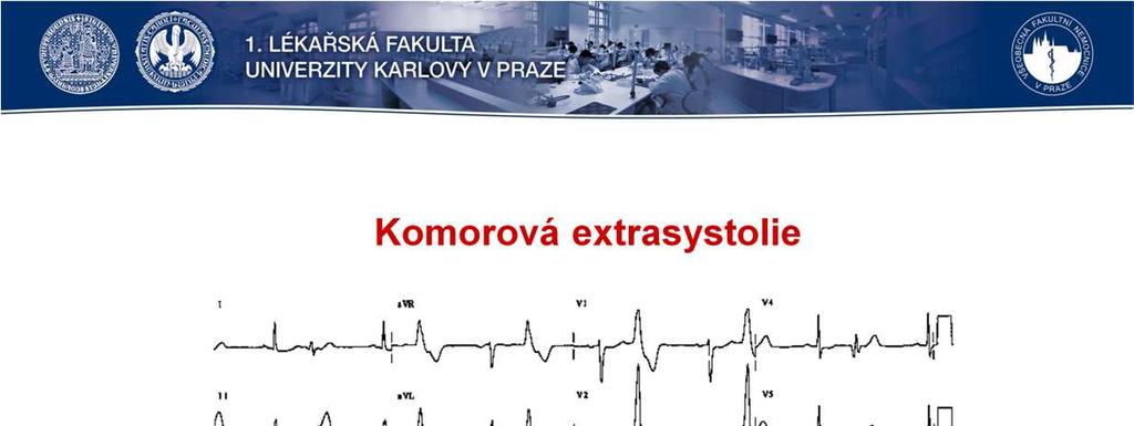 Komorová extrasystola (KES) je relativně častým nálezem a izolované KES můžeme najít i u zcela zdravých jedinců.