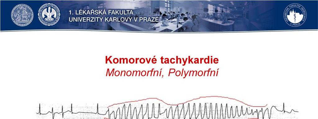 Komorová tachykardie se může objevit nečekaně, a to i u zdravého člověka, závažnější je její výskyt u pacienta s chronickým onemocněním srdce, či její výskyt jako poinfarktové komplikace.