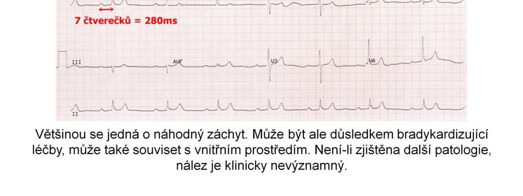 fyziologicky zkracuje a při bradykardii