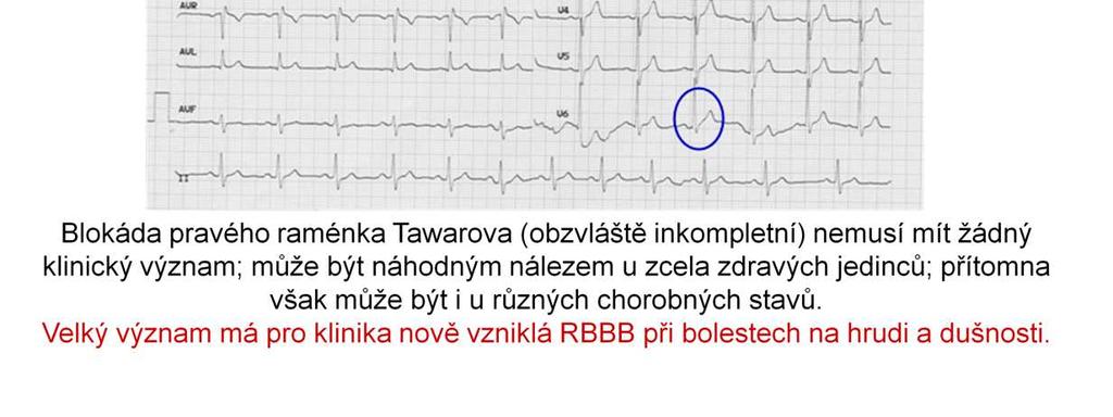 Změněna je jen aktivace pravé komory.