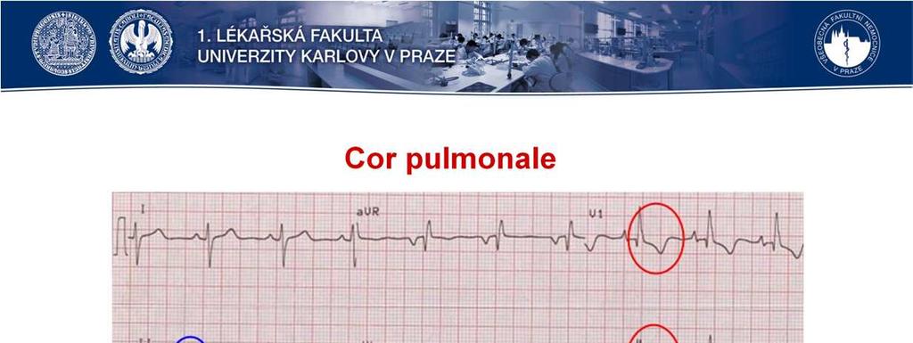 Přetížení pravé komory je častým nálezem zejména u chronických kardiaků. Na EKG nacházíme změny odpovídající RBBB. Ve V1 nacházíme vqrs komplexu koncové pozitivní R nebo rsr.