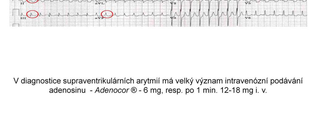 sinu) verapamil betablokátory