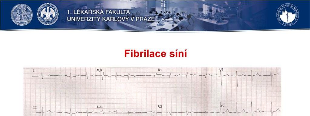 FS je nejčastější poruchou srdečního rytmu a postihuje asi 5 % pacientů